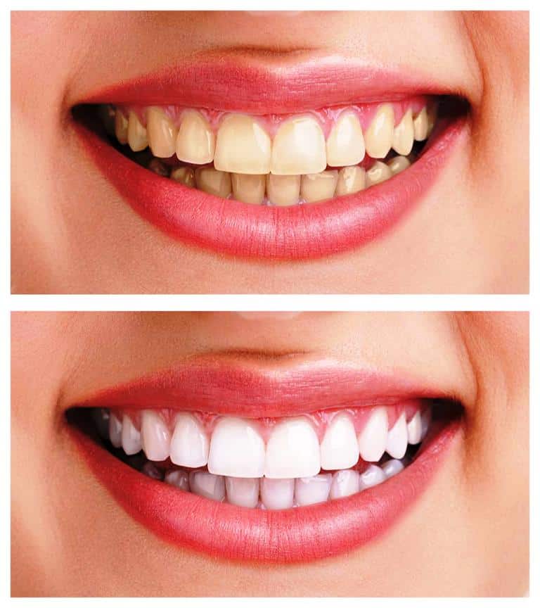 Teeth whitening
